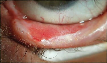 Figure 2. Keratinization of the lower lid in a patient who has a history of limbal stem cell deficiency resulting from Stevens-Johnson syndrome.