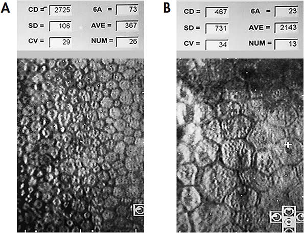 Figure 3. Specular microscopy of corneal graft tissue after transplantation. (A) One-year post-PK, normal cell density, note relatively uniform size and shape of cells. (B) 32-year post-PK, severely decreased cell density with obvious pleomorphism and polymegethism.