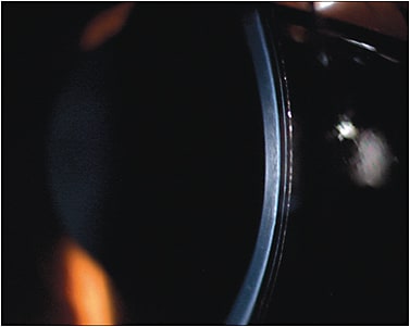 Figure 8. Mini-scleral lens on the patient’s left eye.