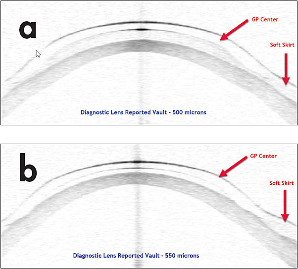 Figure 3. The same keratoconic cornea with a 500µm vault lens (a) and 550µm vault lens (b), both observed after 5 minutes. Note the excessive clearance of the 500µm vault lens and less tear layer with the the 550µm vault lens.