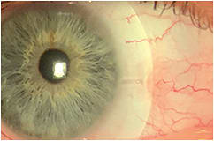 Figure 2. Resolved pingueculitis while wearing a scleral lens with a localized vault.