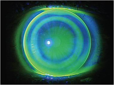 Figure 1. Fluorescein pattern of hyperopic orthokeratology for the Case 1 patient.