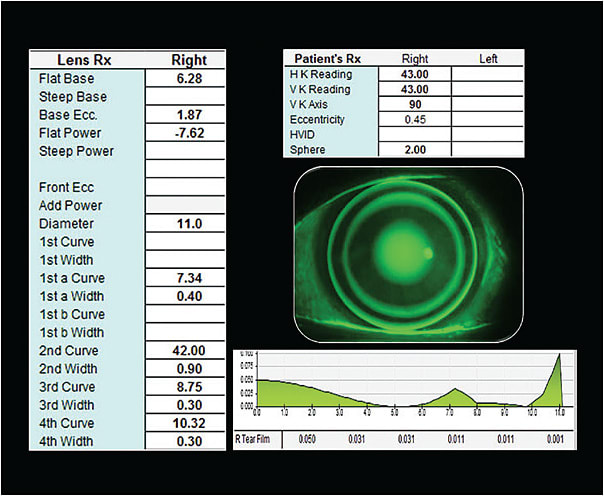 Figure 4. The final lens parameters to create a hyperopic orthokeratology lens.