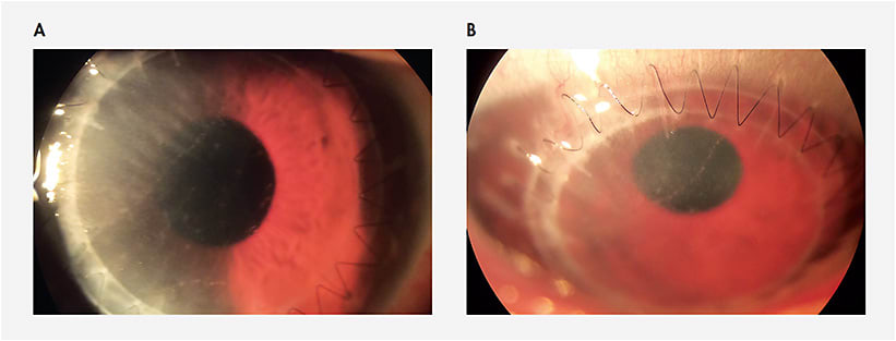 Figure 9. Graft rejection approximately three months after femtosecond laser-assisted PK. Note ciliary flush, superior-temporal sectoral corneal edema, keratic precipitates, Khodadoust line, and loose superior temporal sutures. This patient complained of reduced vision, ocular irritation, and redness.