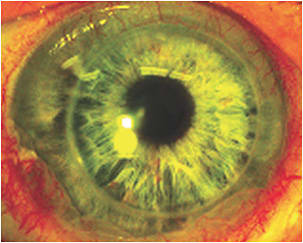 Figure 3. The patient immediately after reapplication of the lens.