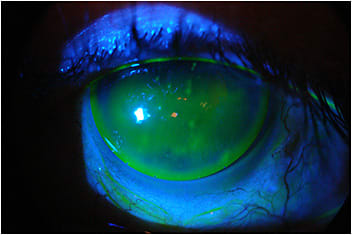 Figure 2. Evidence of the previous poor lens fit seen under the intralimbal GP trial lens.