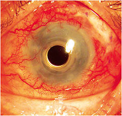 Figure 1. 16mm soft lens that had poor stability.