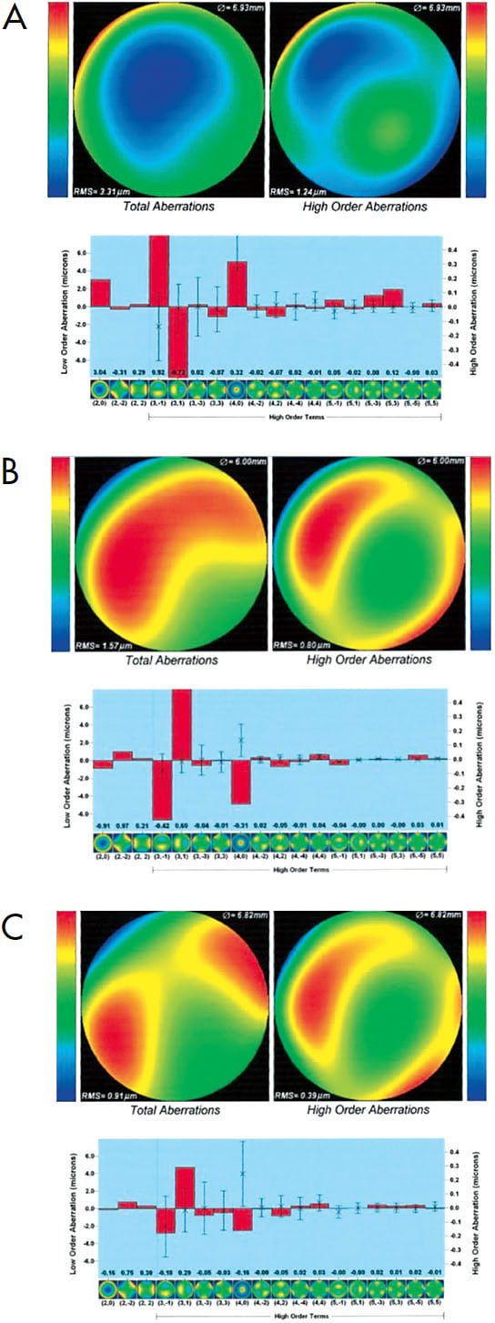 Figure 13. Measurement of higher-order aberrations (HOAs) through aberrometry can be used to improve residual visual distortion from HOAs in contact lenses. Measurements of HOAs were taken in a patient wearing a front-surface scleral lens that incorporated low-, mid-, and high-eccentricity. Note that the low- (A) and high-eccentricity (B) optics produce larger amounts of aberrations, while the mid-eccentricity (C) lens allowed for reduced total aberrations and HOAs. With the mid-value lens, this patient noted significantly improved quality of vision.