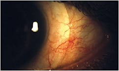 Figure 4. An impression-based scleral lens was ultimately needed to alleviate hyperemia.