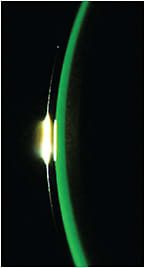 Figure 1. A scleral lens with a vault approximately 1:1 with the lens thickness.