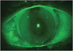 Figure 3. Bitoric corneal GP lens on the patient&amp;#8217;s left eye.