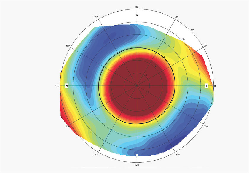 Figure 9. The patient’s left sclera has 255 microns of oblique scleral toricity.