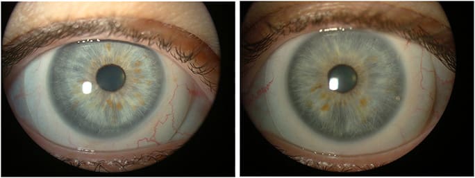 Figure 2. Scleral lens fit OD (left) and OS (right) showing adequate scleral alignment.