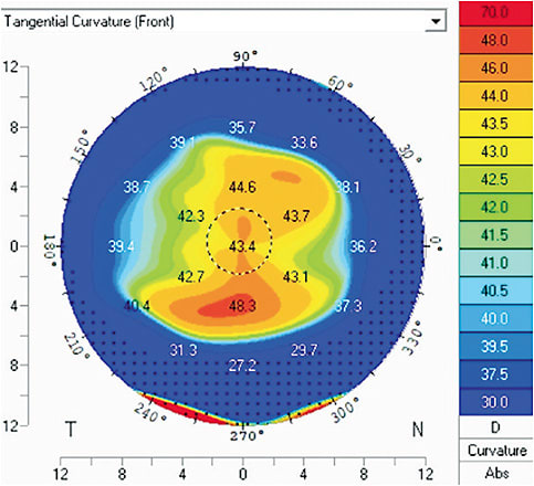 Figure 1. Tangential map demonstrating irregular astigmatism.