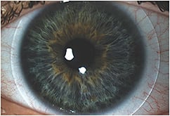 Figure 1. A commercial soft lens fit on an eye that has a larger-than-average HVID.