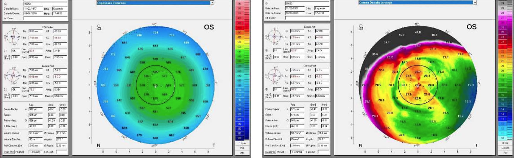 Figures 13 and 14. OS corneal thickness and corneal density average maps.