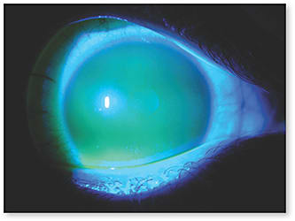 Figure 5. Some scleral lens designs are manufactured with rotational multifocal optics. Scleral lenses vault over the cornea and correct high amounts of regular and irregular corneal astigmatism.