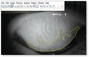 Figure 1. Meibography image analysis. The freehand tool in ImageJ was used to select the area of meibomian gland loss.