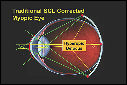 Figure 2. The peripheral hyperopic defocus created by traditional daily disposable soft contact lenses.