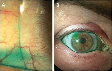 Figure 1. Lissamine green instilled after lens application. (A) A mild influx of the dye in the post-lens fluid reservoir. (B) Mild influx of the dye from the superior area. Lissamine green appears clearly beneath the lens in different peripheral areas. The image also shows nasal conjunctival staining. Courtesy of Hector Velasquez