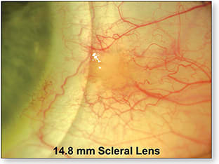 Figure 3. A 14.8mm scleral lens positioned just inside of the elevated pinguecula.