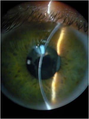 Figure 5. Cross-section view of the cornea