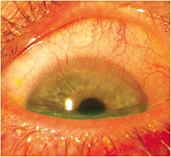 Figure 2. Right eye at one-week follow up showing marked improvement.
