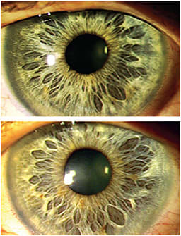 Figure 3. Custom soft toric lenses OD (top) and OS (bottom) for Case 2 patient demonstrating good coverage and centration and essentially no rotation (marking at 9 o’clock). Note the large corneal diameters.