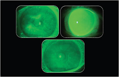 Figure 1. The ocular surface prior to and post-six weeks of scleral lens wear.