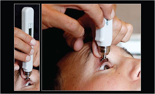 Figure 1. IOP measurements using the Diaton device. IOP is measured through the superior lid, which should be retracted to approximately 1mm beyond the limbus.