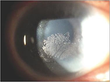 Figure 5. Deposits on the surface of a scleral contact lens.