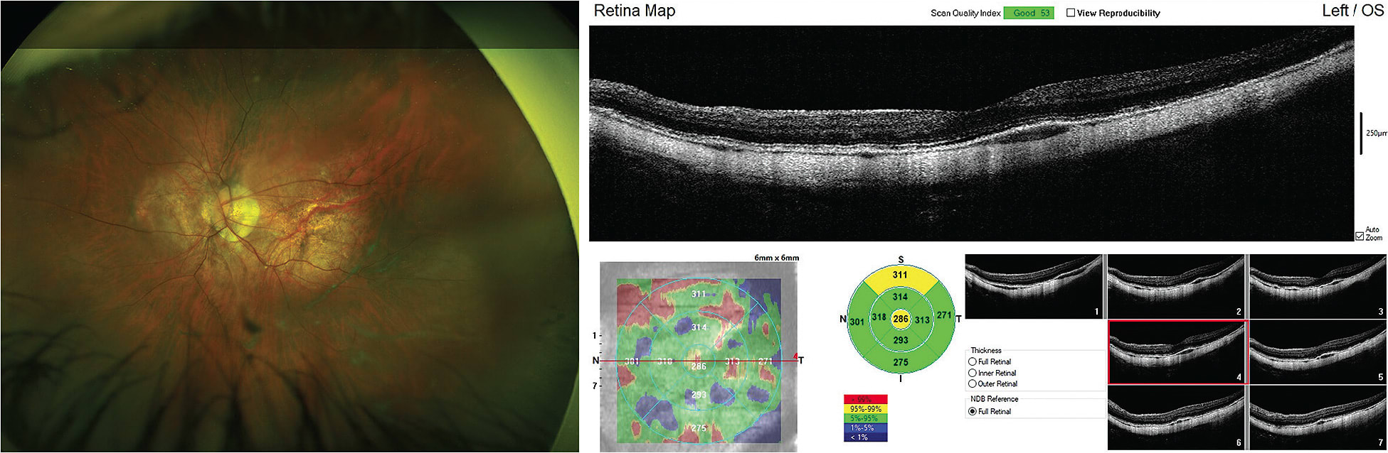 Figure 1. (Left) Retinal photography showing maculopathy and (right) optical coherence tomography showing disruption in the macular area of a patient who has –14.00D of myopia and best-corrected Snellen visual acuity of 20/30. Images courtesy of Sheila Morrison, OD