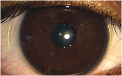 Figure 2. Largest diameter (14.5mm) daily disposable soft toric in-office trial lens on eye. Patient reports discomfort due to lens awareness with each blink.