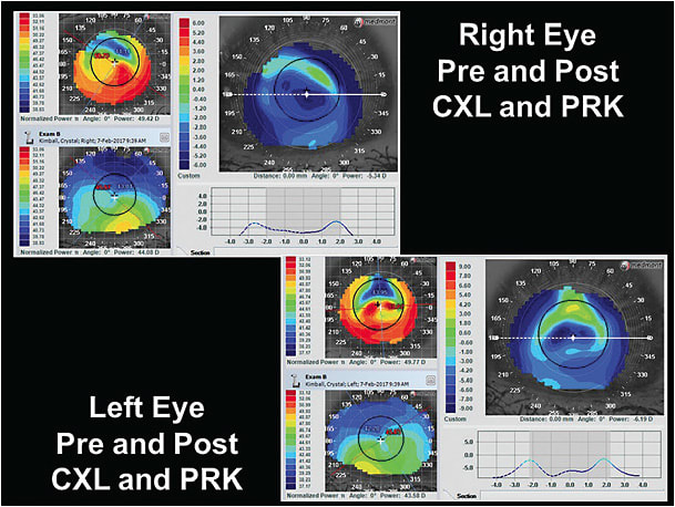 Figure 2. Right eye and left eye difference display maps pre- and post-CXL and PRK.