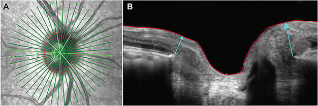Figure 1. The BMO-MRW is the minimum distance from Bruch’s membrane opening (BMO) to the internal limiting membrane of the retina. To measure this, radial scans around the ONH are acquired using OCT (green lines) (A), and for each cross-section (B), the BMO-MRW distances (blue arrows) are measured in µm and averaged between all cross-sections. This metric naturally decreases throughout the day,34 more markedly so during increases in IOP.7,9
Photos courtesy of Dr. Maria Walker.