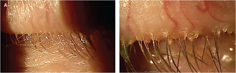 Figure 4. (A) Assessment of the eyelid margin on low magnification (10x slit lamp magnification). (B) Assessment of the same lid margin on high magnification. Note the additional appreciation of the deposits at the base of the lashes when the magnification is increased (25x slit lamp magnification).