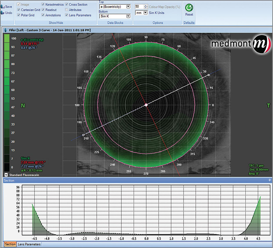 Figure 2. Simulated fluorescein pattern of a corneal GP lens via empirical design topography-based software.