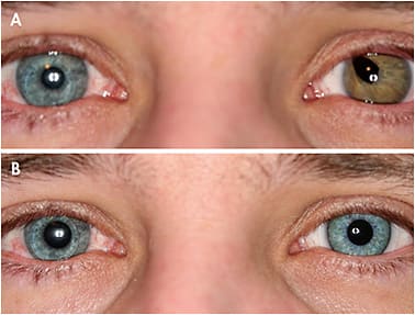 Figure 5. (A) Shows a congenital coloboma microphthalmia defect. (B) The same eye fit with a hand-painted spherical soft custom contact lens.