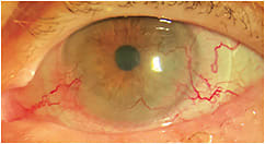 Figure 3. Bandage soft contact lens for a patient with NK post-herpes zoster.