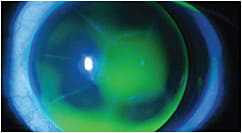 Figure 4. A spherical intralimbal GP lens on a post-RK cornea.