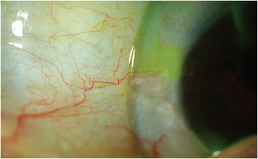 Figure 2. Fluorescein seeping under the edge of a lens adjacent to a pinguecula. The patient may experience edge awareness in this region. Upon administration of fluorescein, the edge lift is identified without the need for cobalt light.