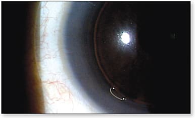 Figure 6. Air trapped at the junction of the hard and soft portions of a hybrid lens for normal corneas. When this happens, the lens will always be more comfortable when it is removed and reapplied.