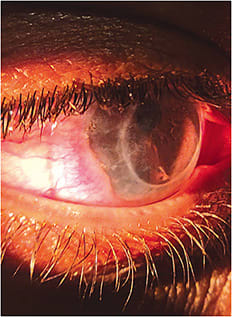 Figure 1. Scleral lens-induced prolapse that is occurring inferior-temporally.