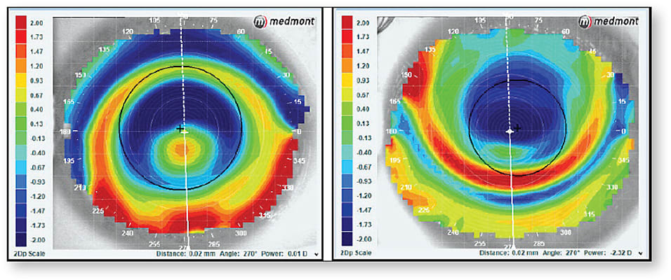 Figure 4. Central island (left) and superiorly decentered treatment zone (right).