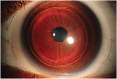 Figure 2. First dispense of an empirically ordered hybrid lens. Note the excellent centration, and visual quality was comparable to spectacle lens acuity.