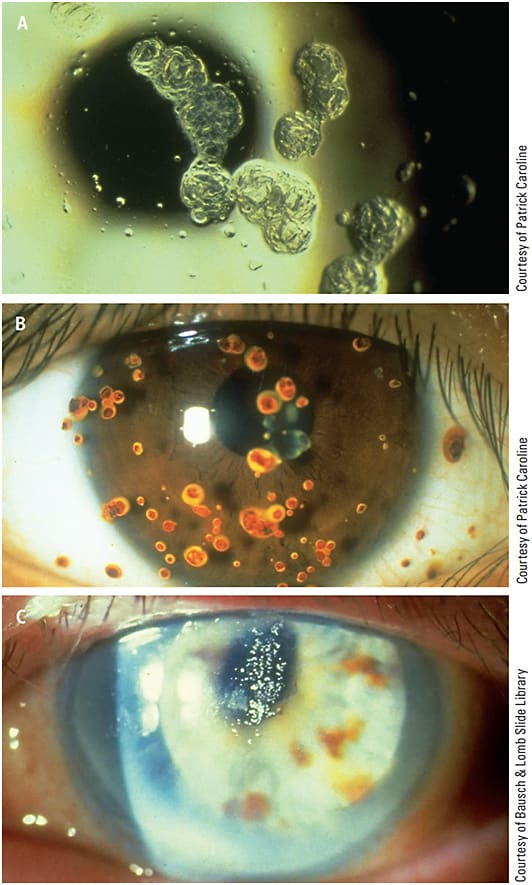 FIGURE 2. Long-term visible deposit formation on early-generation hydrogel lenses. (A) jelly bumps; (B) rust spots; and (C) calcium deposits.