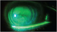 Figure 1. Corneal impression from a tight-fitting hybrid lens.