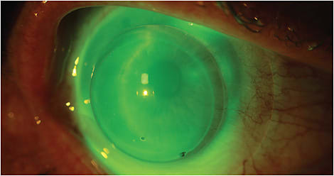 Figure 4. Piggyback lens system with good GP lens centration after corneal transplantation.