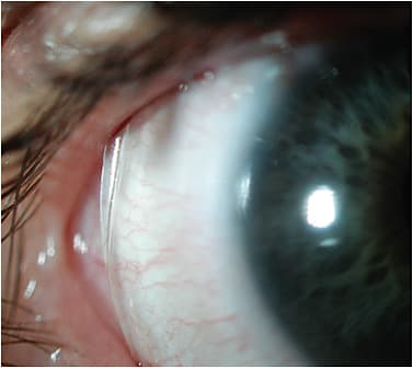 Figure 4. If there is an air meniscus at the edge, the patient will definitely experience discomfort with the lens.