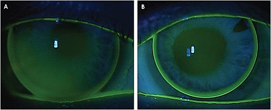 Figure 1. A successful fit of a lenticulated GP lens on both the (A) right and (B) left eyes of the patient in Case 5.